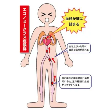 注意！エコノミークラス症候群の原因と予防について解説 