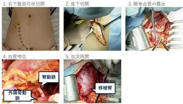 腎臓病と腎移植後合併症 