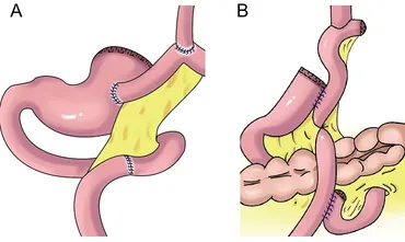 Digestive tract reconstruction after laparoscopic proximal gastrectomy for Gastric  cancer: A systematic review