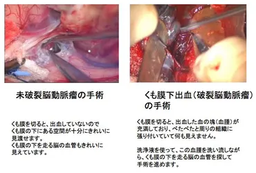 くも膜下出血