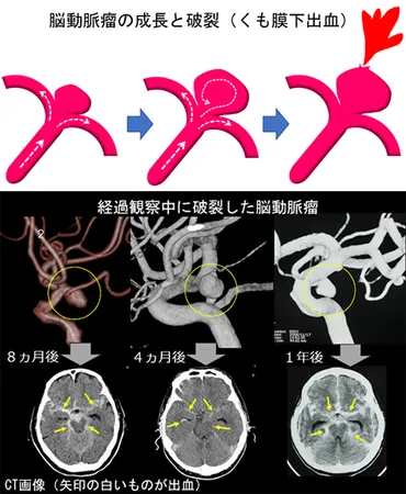 脳動脈瘤