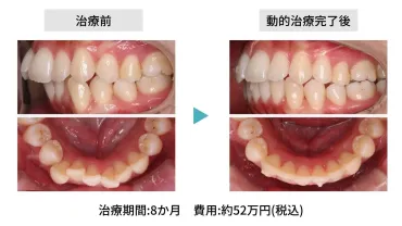 安いマウスピース矯正、やらなきゃよかった…。リスクと後悔しないコツをご紹介 