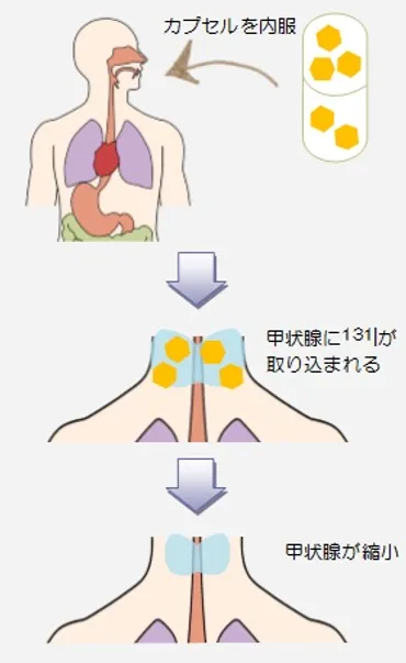 放射性ヨウ素(131I)内用療法について ～バセドウ病の治療～ – Radiology@Home