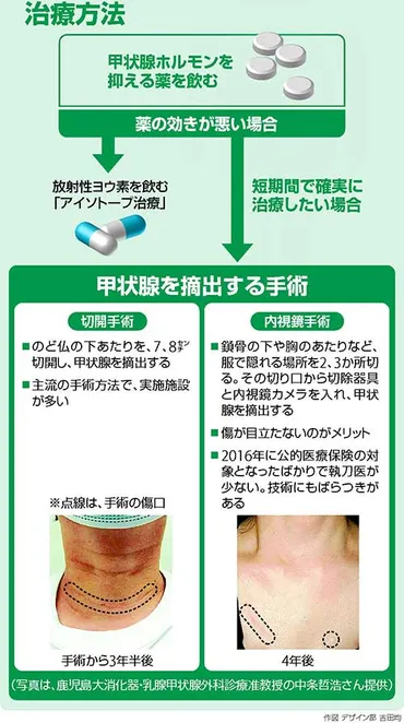 バセドウ病の手術 「内視鏡」公的医療保険の対象に…傷も目立たず 