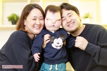 世界でも前例なし難病゛おもちくん゛の両親、おでこの骨やまぶたがない状態で生まれても「存在に感謝」