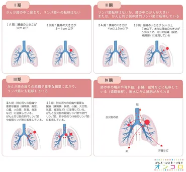 肺がんのステージ(病期)