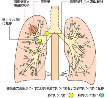 肺がんの大きさと広がり：TNM分類ってなに？ 