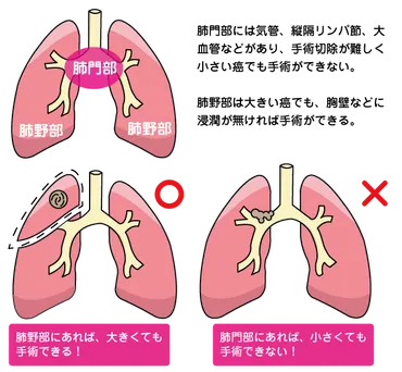 肺がんの治療・手術 