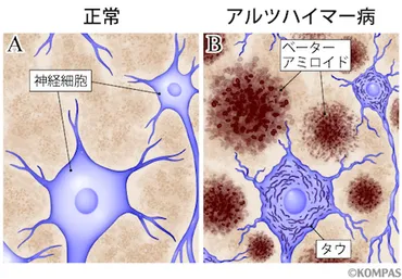 アルツハイマー病の新しい画像検査 ～病因物質、ベーターアミロイドとタウ蛋白を映し出す検査～