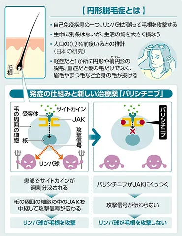 重症の円形脱毛症に新しい飲み薬…抜け毛 国際的な臨床試験で３分の１強の人が改善 