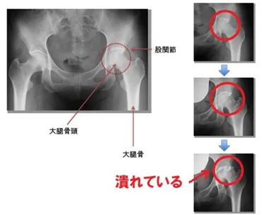 広田レオナ、股関節の痛みと肺がん、そして新型コロナ後遺症!?闘病の軌跡とは!!?