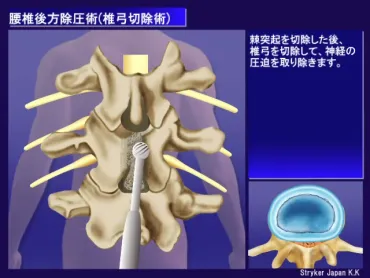 腰椎後方除圧術（ようついこうほうじょあつじゅつ）