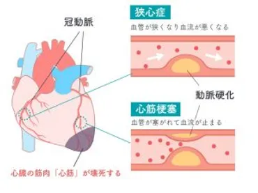 虚血性心疾患について