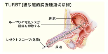 医師監修・作成］膀胱がんの手術：内視鏡手術（TURBT）、膀胱全摘除術などについて 