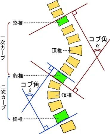 第回側弯症の矯正固定術