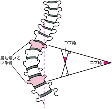 最新医療を駆使した小児脊柱変形手術