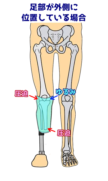 義足ってどんなもの？種類から製作、未来まで徹底解説！(？)義足の構造と機能、製作プロセス、そして未来への展望