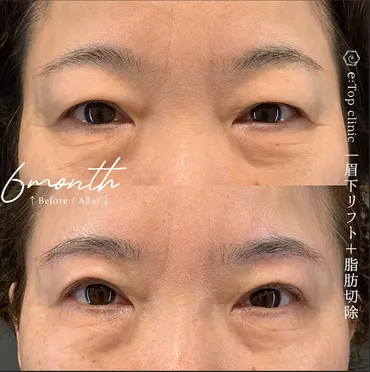 眉下切開は数年後にたるみが戻ることはある?たるみ以外のリスクや眉下 切開がおすすめの人・おすすめできない人などを解説