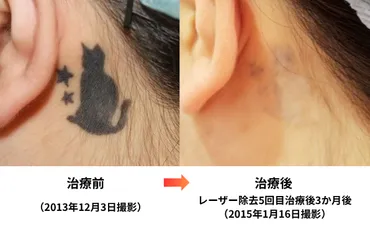 あいみょんタトゥー騒動で除去も殺到?後悔とタトゥー除去の現実