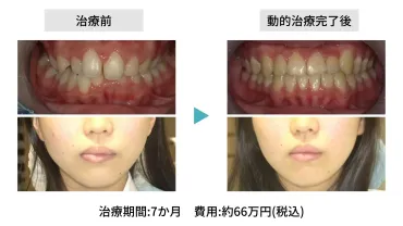 歯列矯正をすると顔が変わる？顔が変わりやすい歯並びってどんなもの？ 