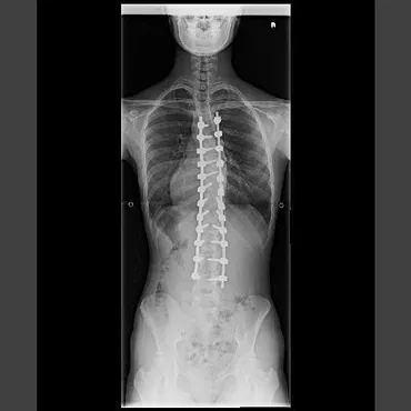 特発性側弯症における治療――装具療法や手術療法の具体的な内容とは