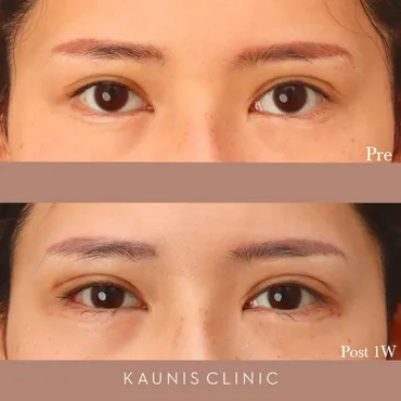 三白眼修正【下眼瞼拡大修正 6か月、1か月、1週】 