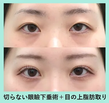 切らない眼瞼下垂手術で左右差調整！ 